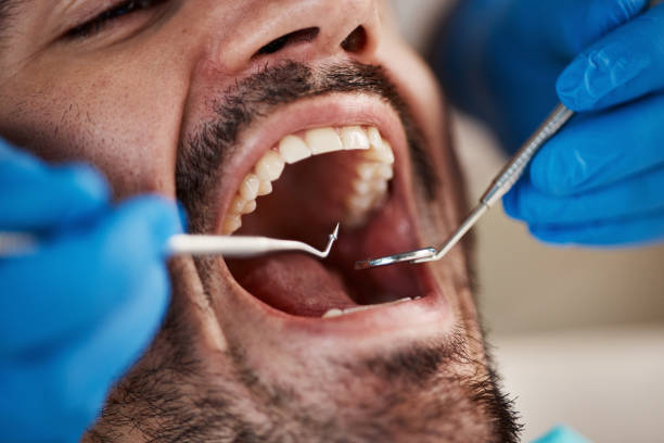Best Emergency Wisdom Teeth Removal in Piedmont, SC